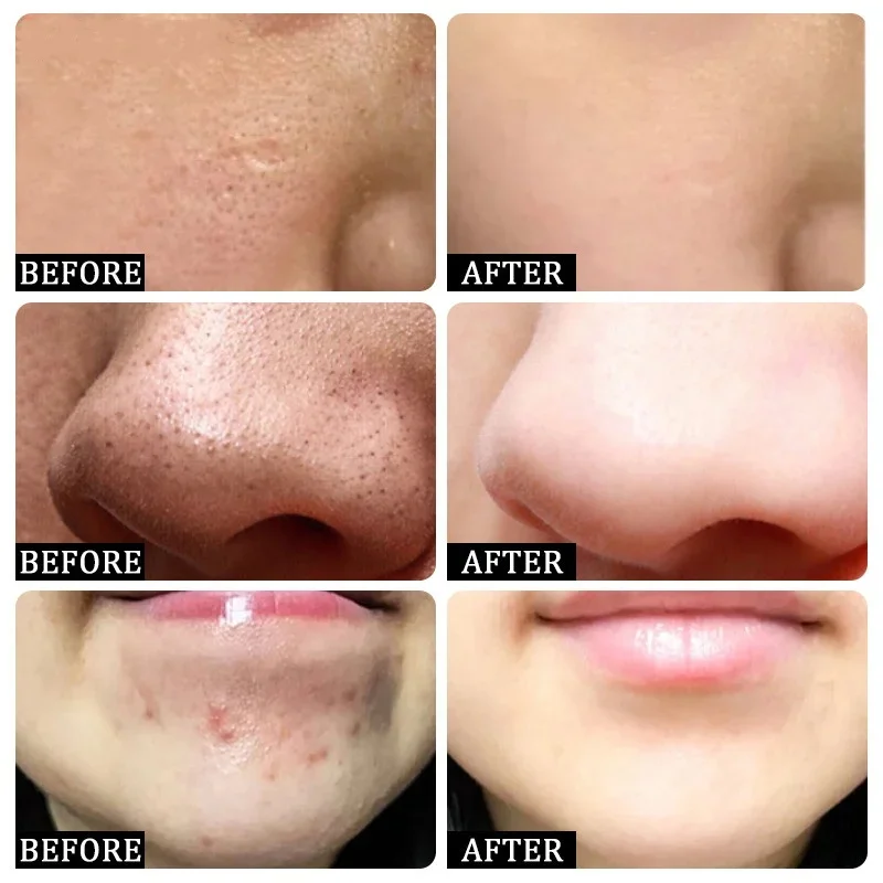 Salicylic Acid Pore Clearing C - Azelaic Acid Cream ulasan dan harga