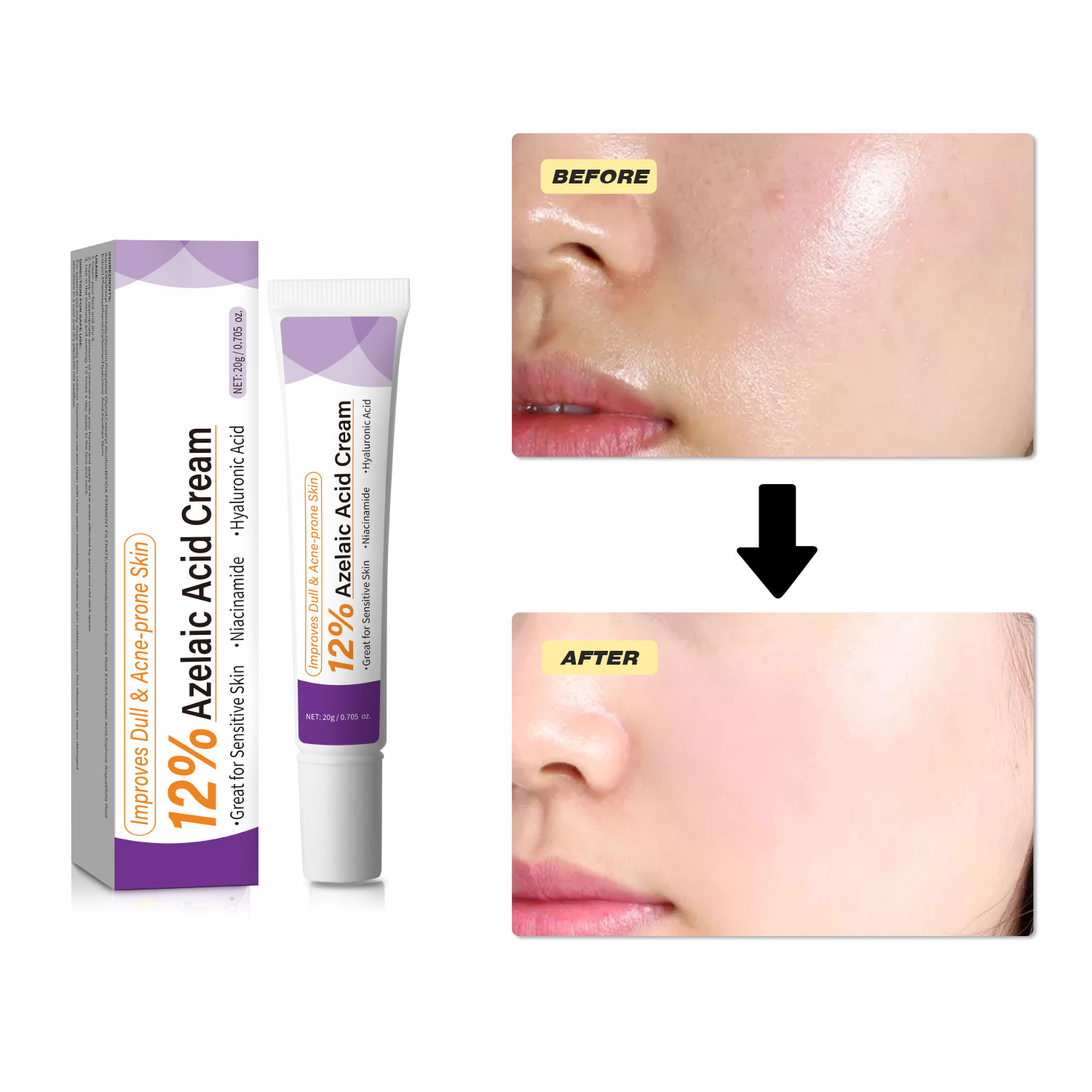 Mild Azelaic Acid Cream Improv - Azelaic Acid Cream ulasan dan harga