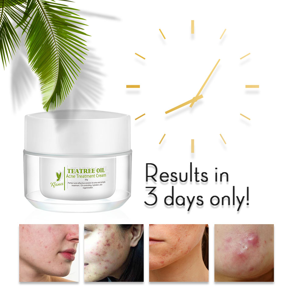 KStims Natural Acne Treatment  - Tea Tree Spot Treatment ulasan dan harga