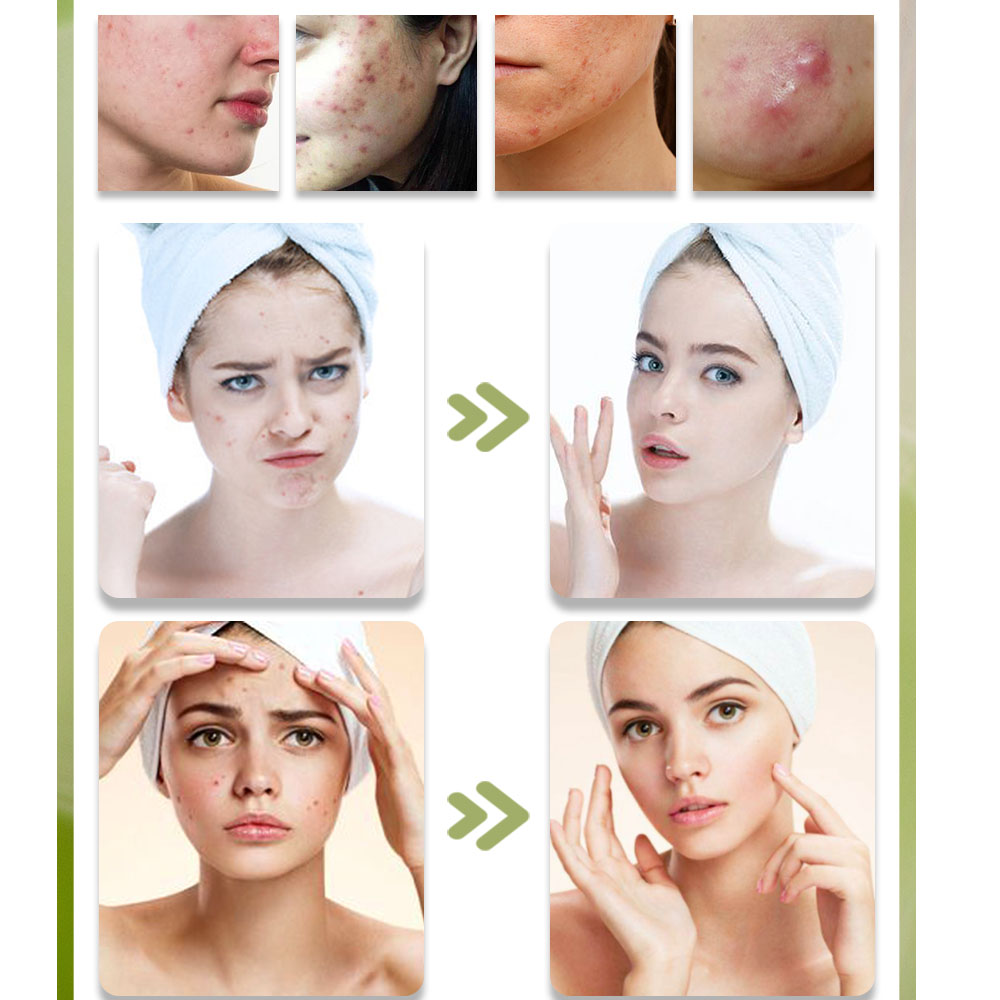 KStims Natural Acne Treatment  - Tea Tree Spot Treatment ulasan dan harga